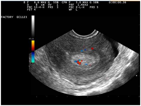 uterine polyp impact blood test|normal uterus polyps.